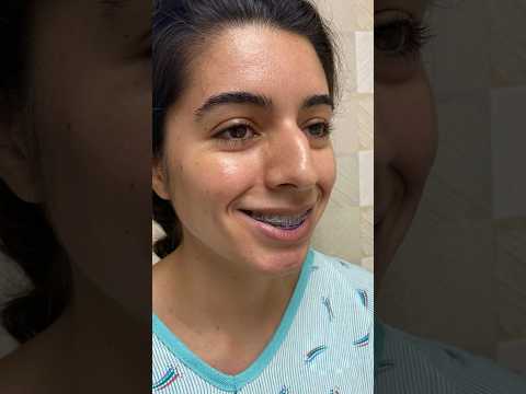 Video thumbnail: Wow It's Me?! | Correction of Asymmetric Nose & Dorsal Hump!