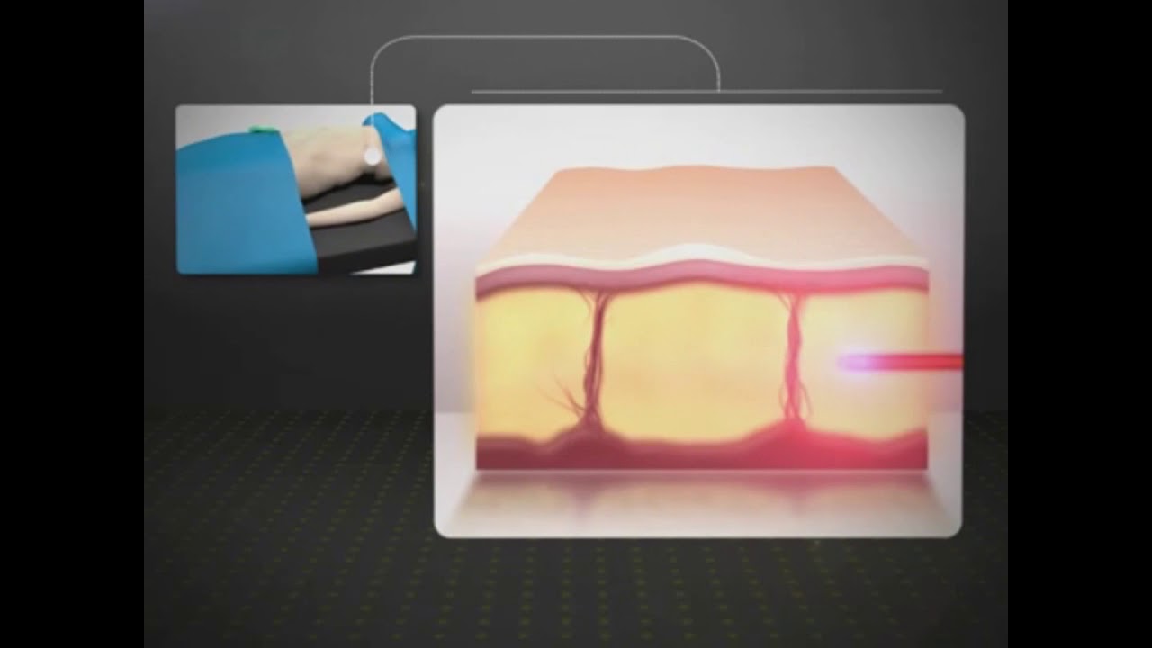 Lipo laser asistida por Diodo YouTube