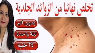 طريقة إزالة زوائد الجلد والثآليل خلال ليلة واحدة .. بدون استخدام مشرط اوحرق او كي نهائيا 