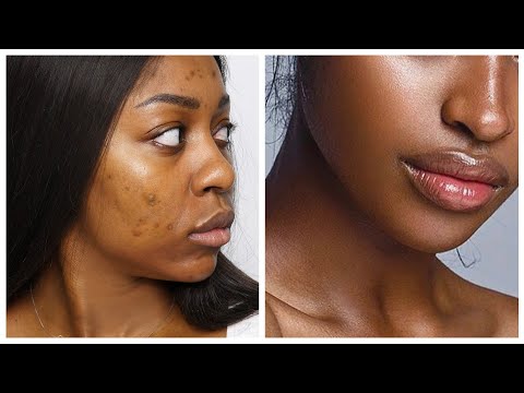 Video: Dovrei vedere un dermatologo per l'iperpigmentazione?