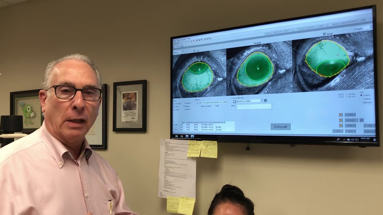 Using the Smap 3-D computer to design the Latitude scleral lens
