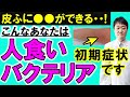 【放置禁止】「人食いバクテリア」劇症型溶血性レンサ球菌感染症の5つの初期症状、治療や予防を医師が解説