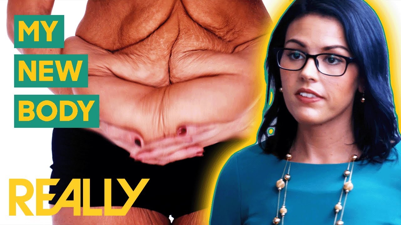 Shedding 10lbs Of Excess Skin After 192lb Weight Loss | My Extreme ...
