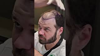 Hair Transplant 5 Month Result Hair Transplant Timelapse Hair Transplant In Turkey