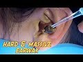 Girl's Hard & Massive Free Earwax Removal in the City