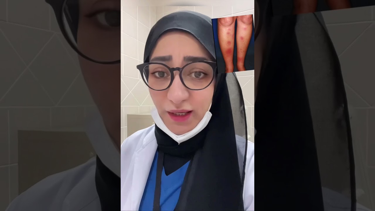 #Erythema #Nodosumالحمامي العقدية