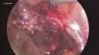 31122018 Laparoscopic exploration ectopic ovarian pregnancy 1301