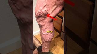 How to get rid of varicose veins.. #shorts Resimi