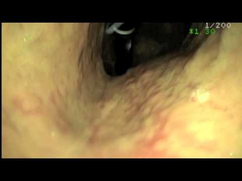 que significa metaplasia escamosa madura endocervical