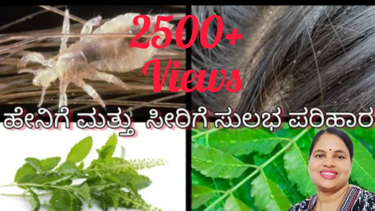 ಹೇನಿಗೆ ಮನೆ ಮದ್ದು ಕನ್ನಡದಲ್ಲಿ/Lice&dandruf remove home remedies in