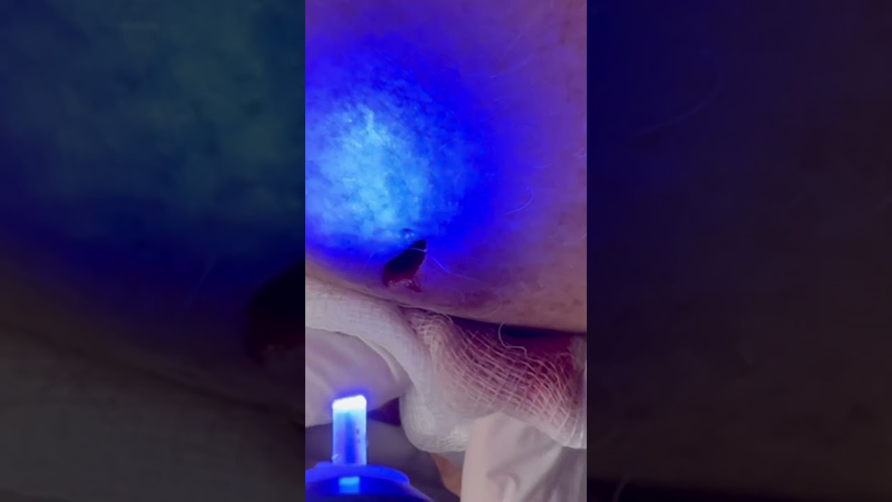 ✅ Лечение раны после вскрытия нагноившейся атеромы #альфано #alfano #атерома #докторгармаев