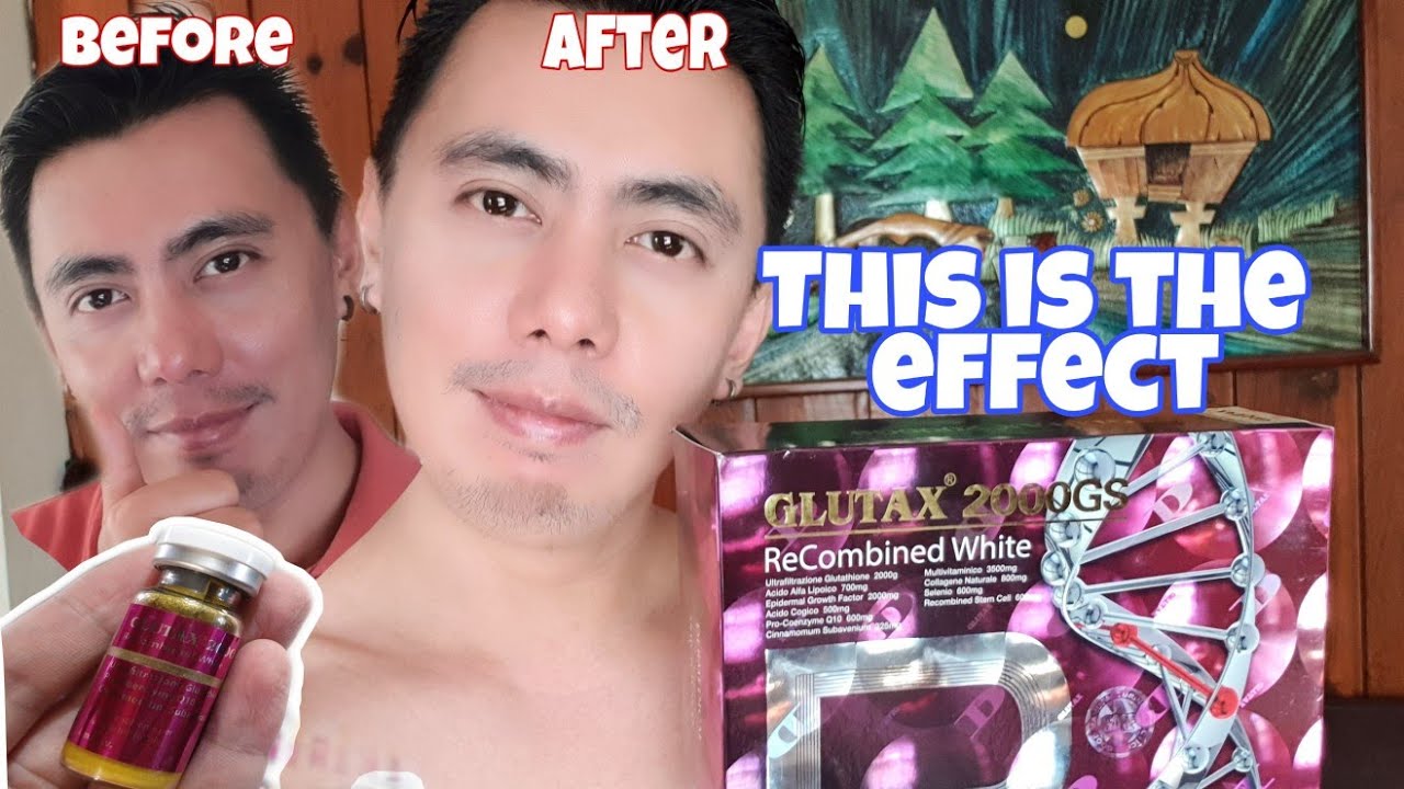 glutax glutathione injectable review 20000000Gn+ Recombined White Injection, Packaging Type: Box at  10000/box in Bengaluru Glutax 50000000GS Advanced Glutathione Injection,