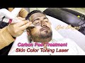 Carbon Laser Facial Treatment for Skin Glow
