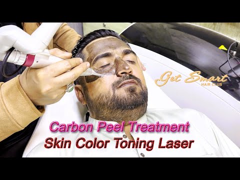 Carbon Laser Facial Treatment for Skin Glow
