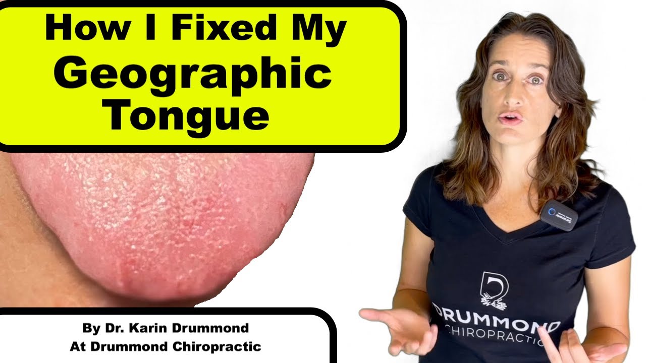 Geographic Tongue Natural Remedies That Work YouTube Music Geographic Tongue Natural Remedies That Work YouTube Music