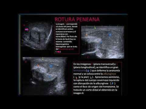 Vídeo: És Possible Una Fractura De Penis?