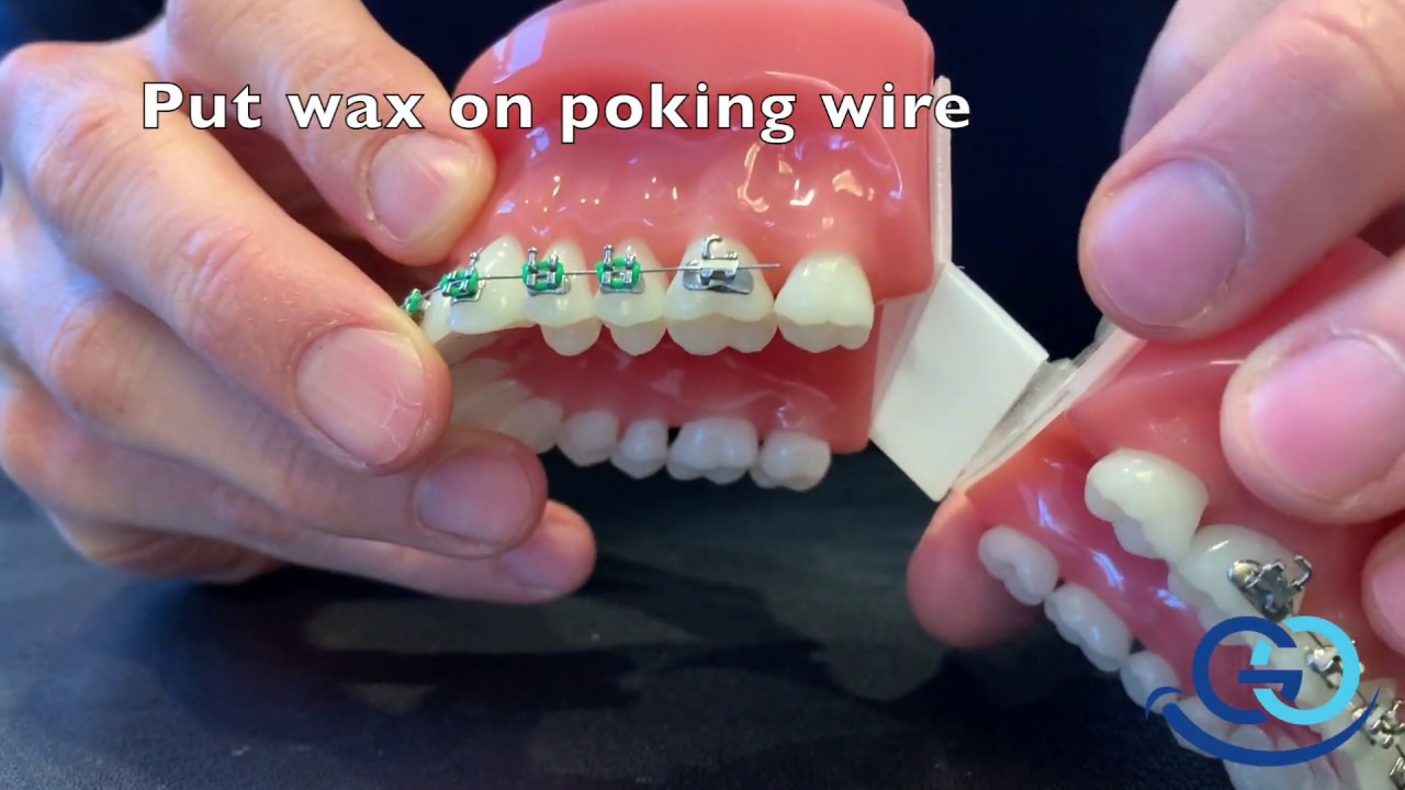 Braces: Put wax on a poking orthodontic wire 