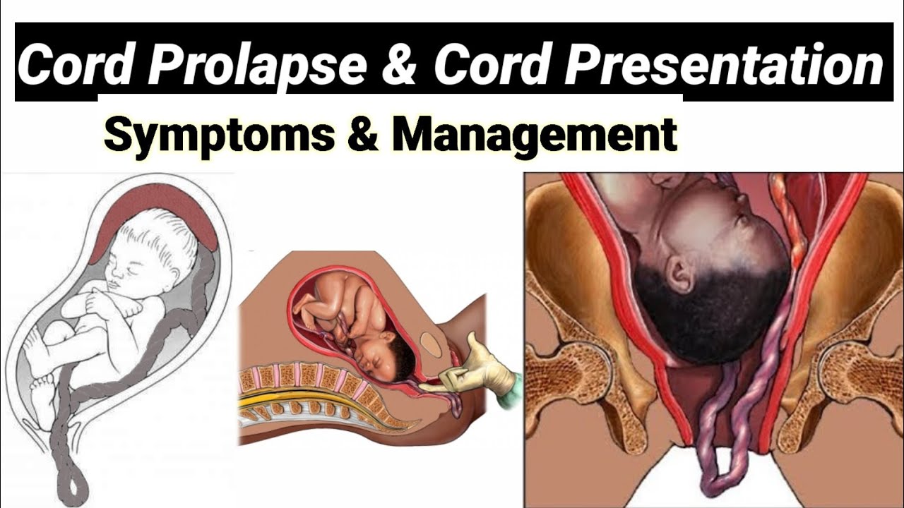 what are the types of cord presentation