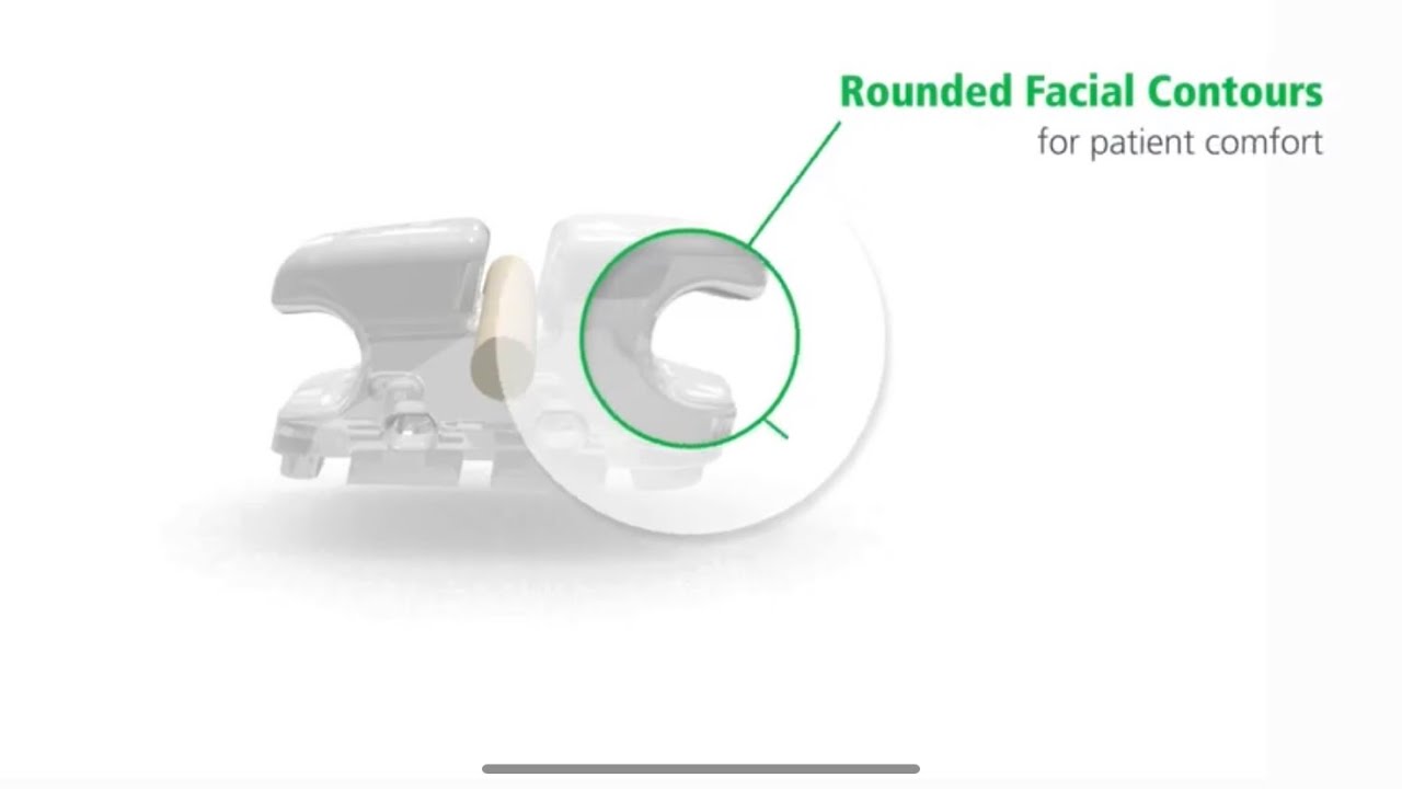 Agility Ceramic Bracket - YouTube
