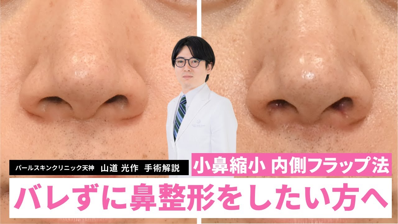 【鼻整形】「小鼻の広がり」は外側を切らなくても治せる？後戻りしない・傷が見えない内側フラップ法とは