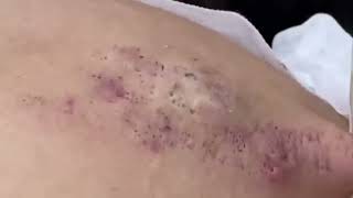 Popping huge blackheads and Pimple Popping - Best Pimple Popping Videos 68