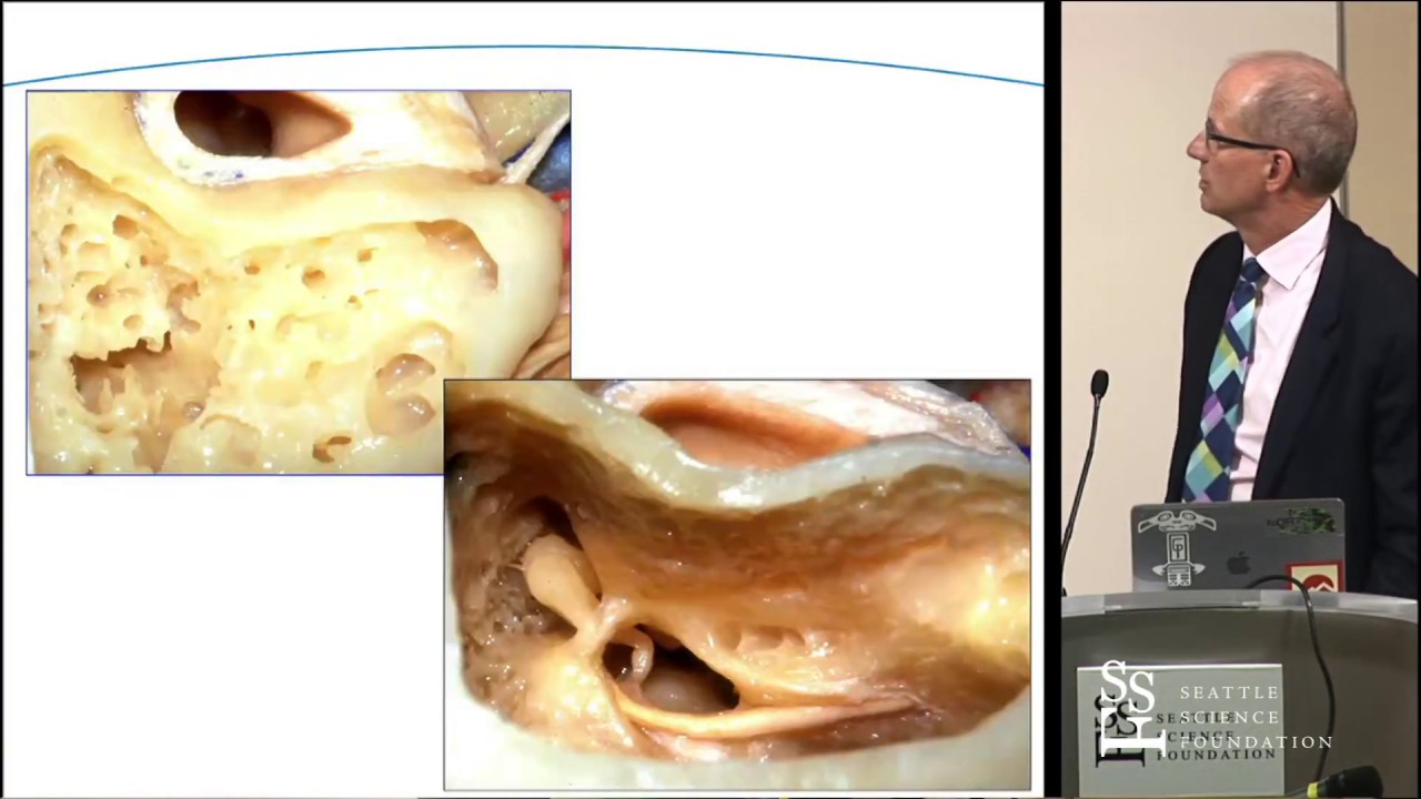 Anatomic Challenges to the Common Approaches for Acoustic Neuroma Surgery Doug Backous, MD