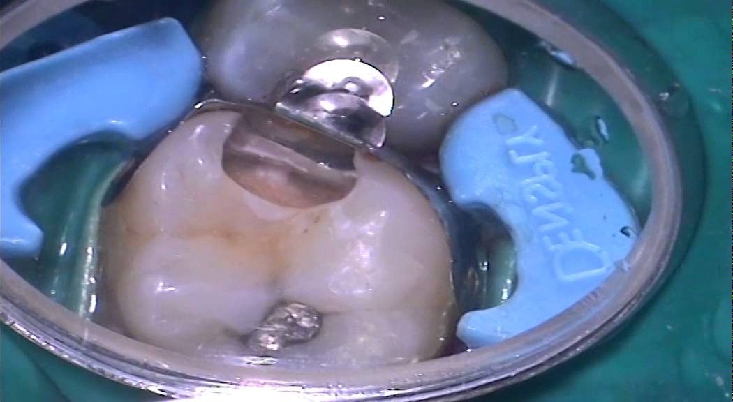 DENTSPLY UK Simplified Posterior Restorations Using Composite Resins by