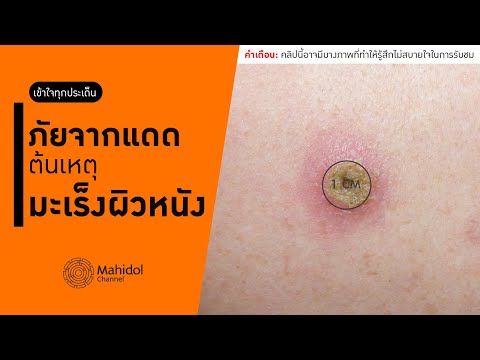 วีดีโอ: มะเร็งผิวหนังและนิ้วเท้า (Melanocytic) ในแมว