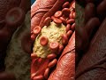 The Dangerous Truth About Cholesterol ! #dyslipidemia #cholesterol #hearthealth