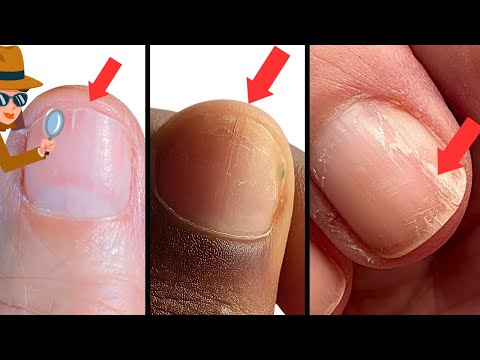 Video: Hoe voorkom je dat nagels naar beneden splijten?