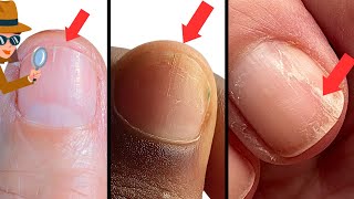 How to Survive Splitting Nails. Causes & Remedies. screenshot 4