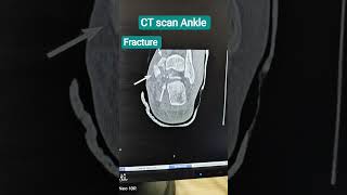 CT scan of Ankle #anatomy #viral #pathology