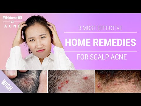 How to Get Rid of Scalp & Back of Neck Acne Naturally! | 3 Most Effective Home Remedies