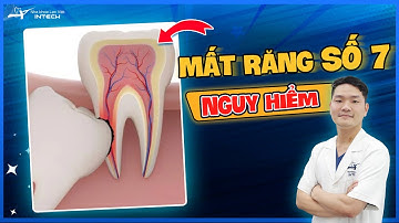 Mất Răng Số 7: Liệu Có Nguy Hiểm? Mất Răng Số 7 Phải Làm Sao?