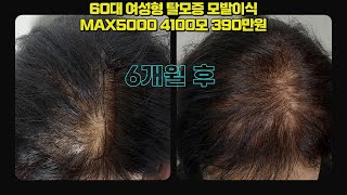 여성형탈모 정수리 모발이식비용 MAX5000 4100모 390만원 (VAT별도) 모발이식 6개월 후 #정수리모발이식#여성탈모#모발이식