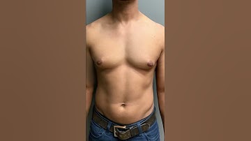 Thumbnail of Gynecomastia surgery by Dr. Lyly at 6 weeks post-op
