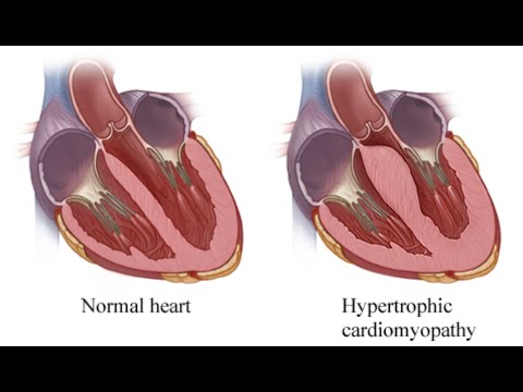 hypertrophic cardiomyopathy subaortic stenosis idiopathic hypertrophy heart dog treatment canadaqbank