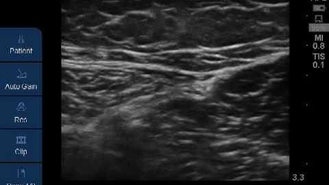 Saphenous nerve ultrasound scan