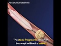 Removing kidney stones surgery||3D Animated video||