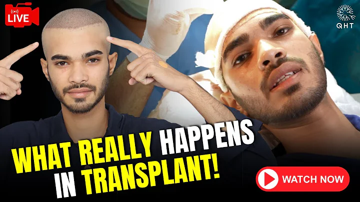 Hair Transplant Surgery | Hair Transplant Live Video | Hair Transplant Procedure | QHT Clinic