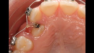 Caso 4. Canino incluido por palatino. Palate displaced canine.
