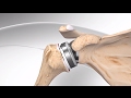 Reverse Total Shoulder Replacement with Univers Revers™ System