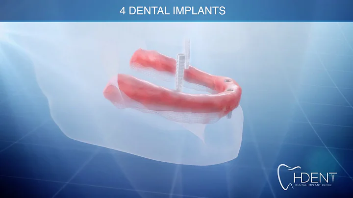 ALL on 4 dental implant procedure   H-DENT