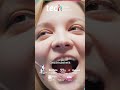 Kieferorthopädische Diagnose in der jungen bleibenden Dentition:Präzision und frühzeitige Prävention