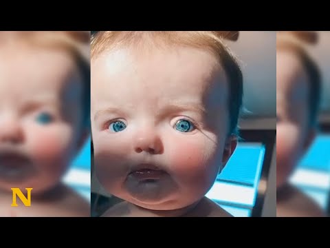 Baby born with striking features proves to have rare syndrome