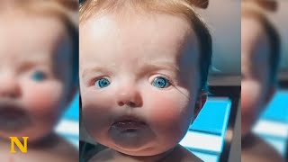 Baby born with striking features proves to have rare syndrome