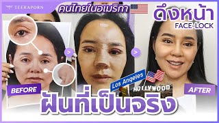 ดูรีวิวเยอะถึงกับเอาไปฝัน บินมาศัลยกรรม 4 อย่างจัดเต็ม คนไทยใน USA ธีรพรคลินิก หมอชลธิศ