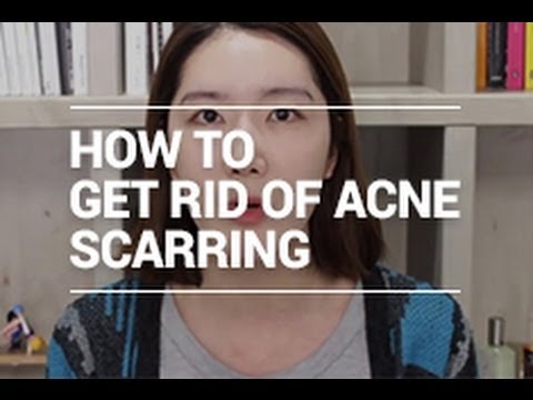 How to Get Rid of Acne Scarring | Wishtrend