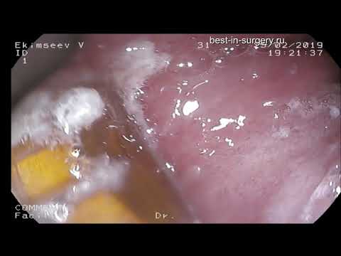 Эндоскопическая радиочастотная абляция (РЧА) пищевода Барретта