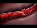 Sickle cell disease animation